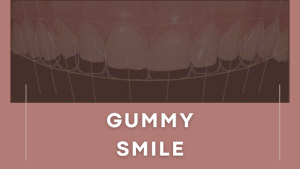 Understanding Gummy Smile and How Surat Ortho Surgery Can Help